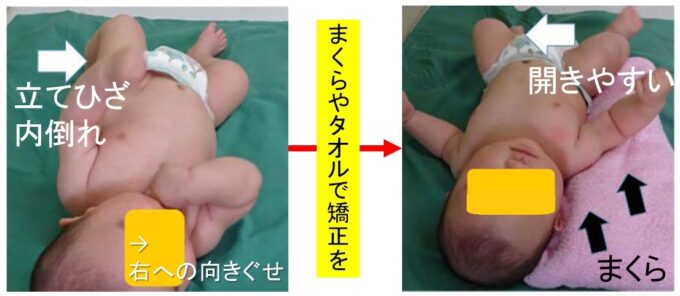 右への向きぐせがある赤ちゃんで、後頭部右側が扁平（斜頭）になっています。また左ひざが股関節に悪い内転位になっています。バスタオルや枕などによる向きぐせへの対応により左股関節の不良肢位は改善されています。こうした毎日少しずつの予防の積み重ねで脱臼が予防されます